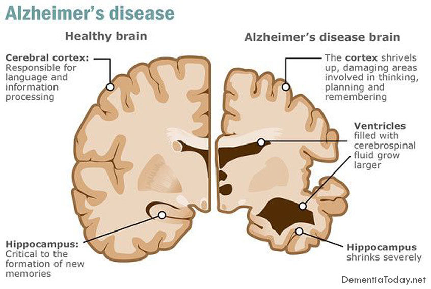 Study examines inosine to increase urate levels in patients with Parkinson disease