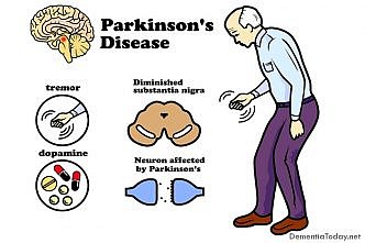 Drug discovery for Parkinson’s disease: LCSB researchers grow neurons in 3-D