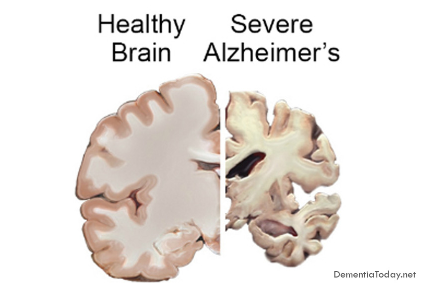 Scientists isolate genes that delay Alzheimer’s