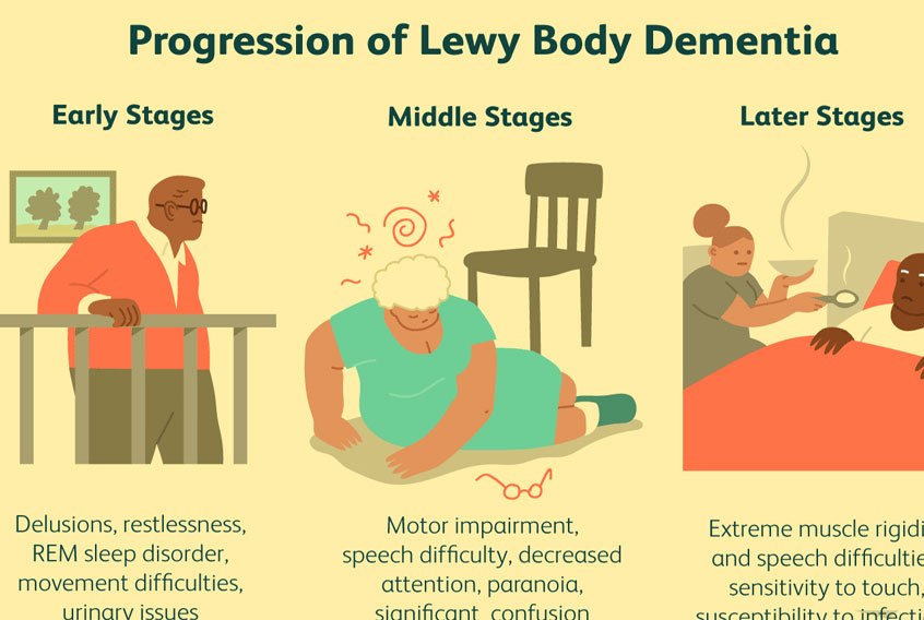 Lewy body dementia